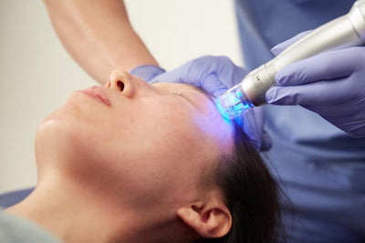 5 Reasons Microneedling RF Treatment Is the RIGHT for You!